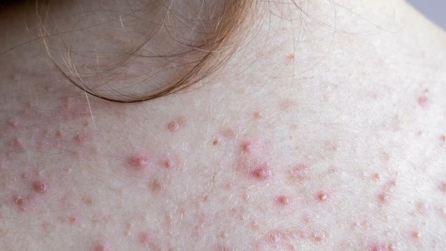 Everything you need to know about back acne