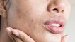 10 OTC skincare ingredients to treat acne