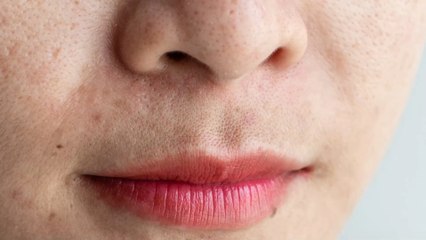 Skinceptance: Superdrug announces new free skin consultation service