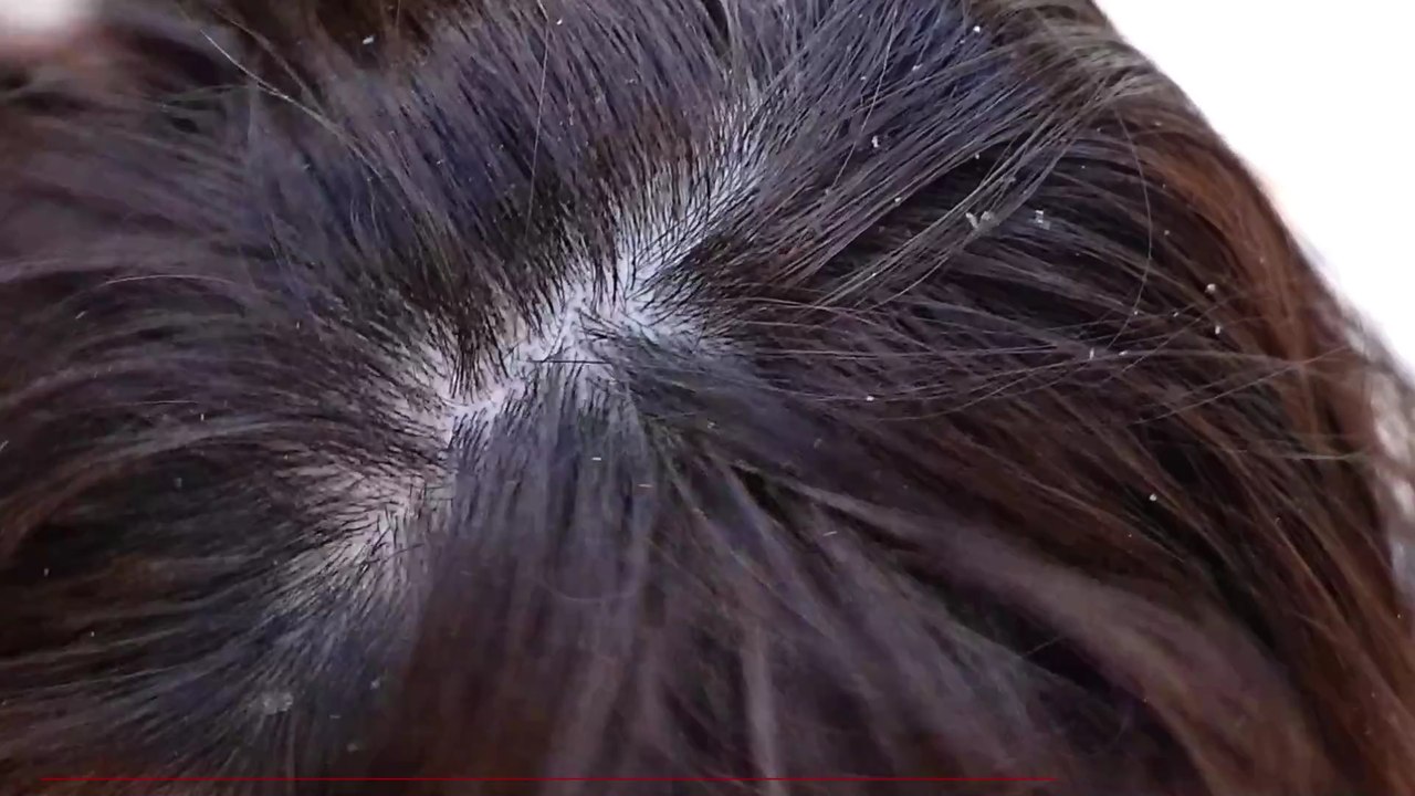 Dandruff: Here's what your flakes say about your scalp condition