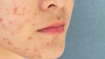 Understanding what triggers hormonal acne and how to treat it