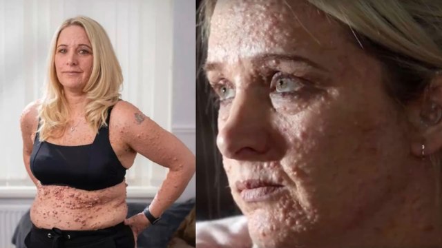 This body positive woman proudly bares her skin disease