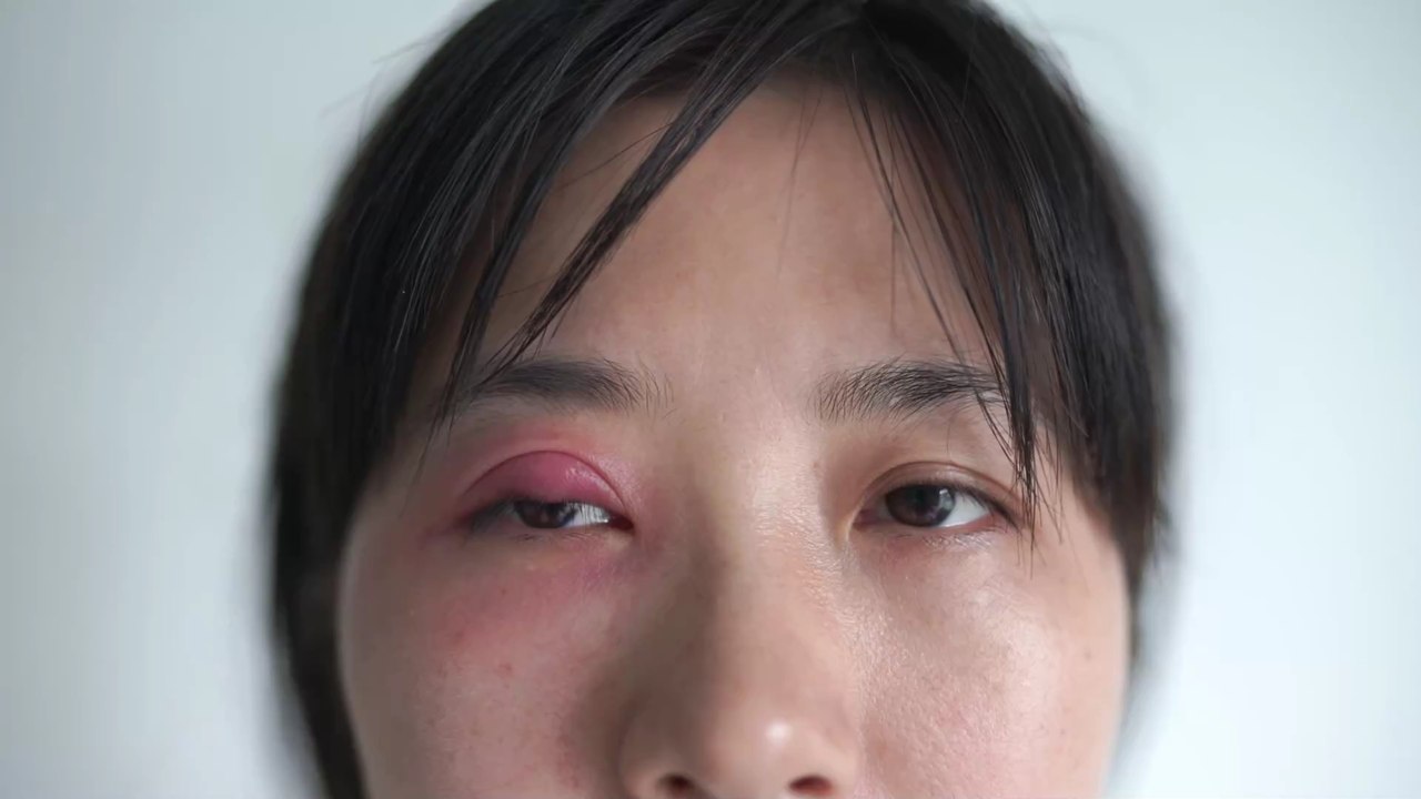 Say goodbye to your stye with these natural remedies