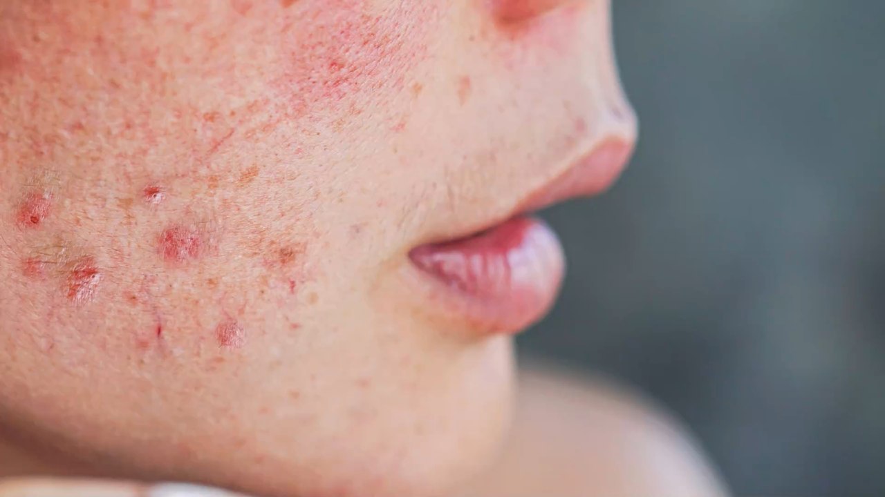 How to reduce acne redness