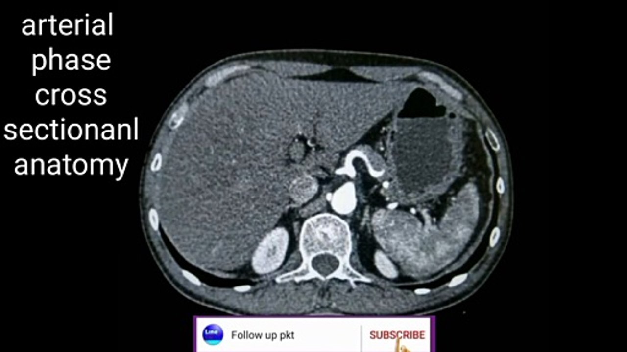 Arterial phase cross-sectional anatomy