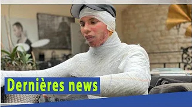 Olivier Rousteing, défiguré dans une explosion : il revient sur le drame