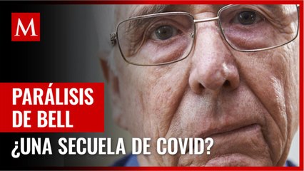 ¿Qué es la parálisis de Bell, la complicación que puede dar después de covid?