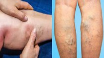 Legs में ऐसे Marks होना इस जानलेवा बीमारी के Symptoms, क्या है कारण और बचाव| Boldsky