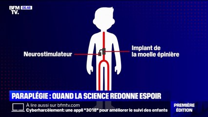 Trois personnes paraplégiques parviennent à remarcher grâce à la science