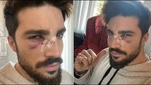 Mariano Di Vaio su Instagram con il volto tumefatto Dovrò rifare il naso