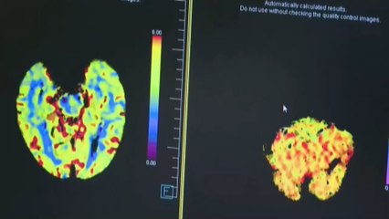 Un cambio en el tratamiento del ictus reduce los pacientes con secuelas graves