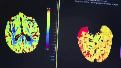 Ensayo sobre el ictus en el Hospital Clínic de Barcelona