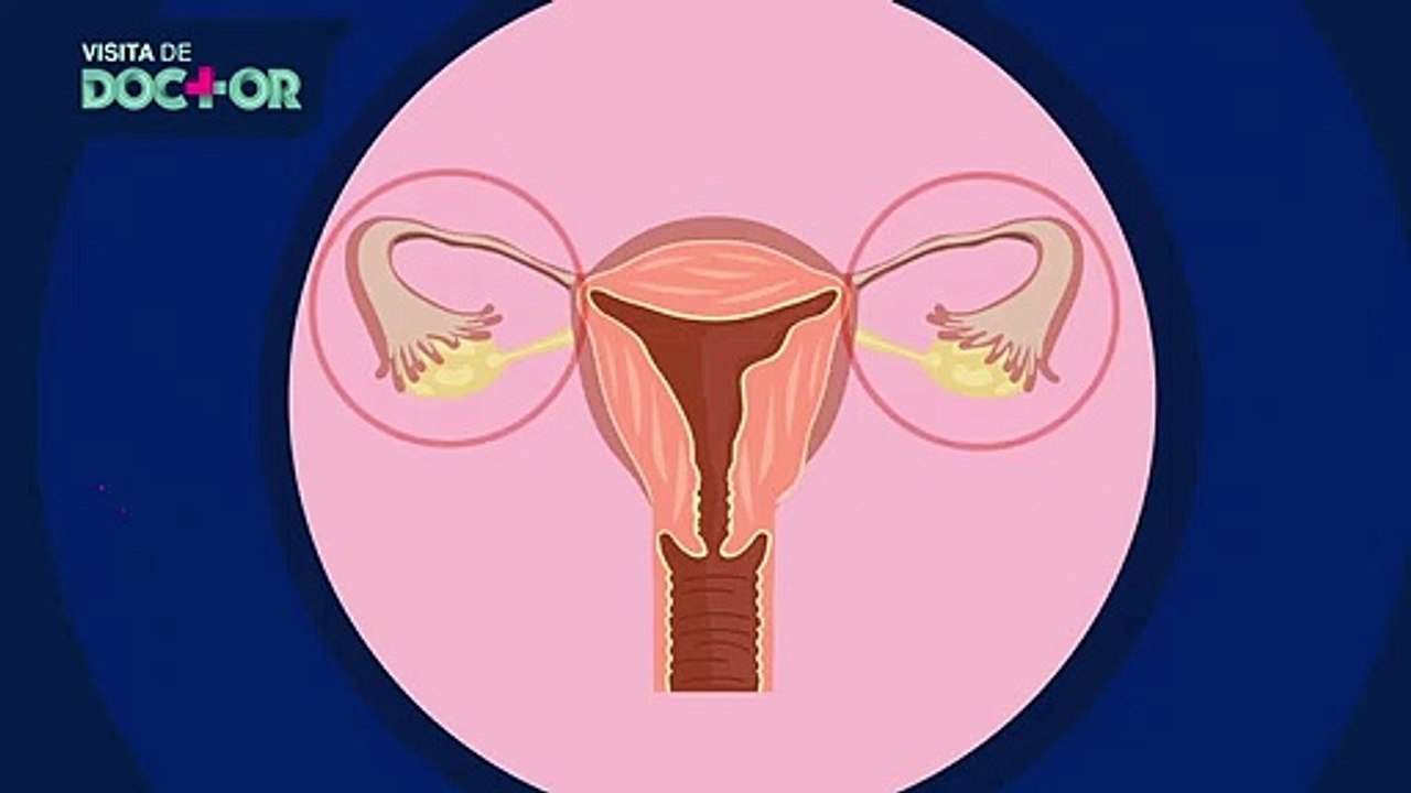Histerectomía: ¿a quiénes se realiza? | Salud180
