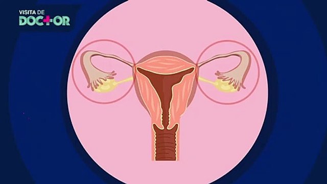 Histerectomía: ¿a quiénes se realiza? | Salud180