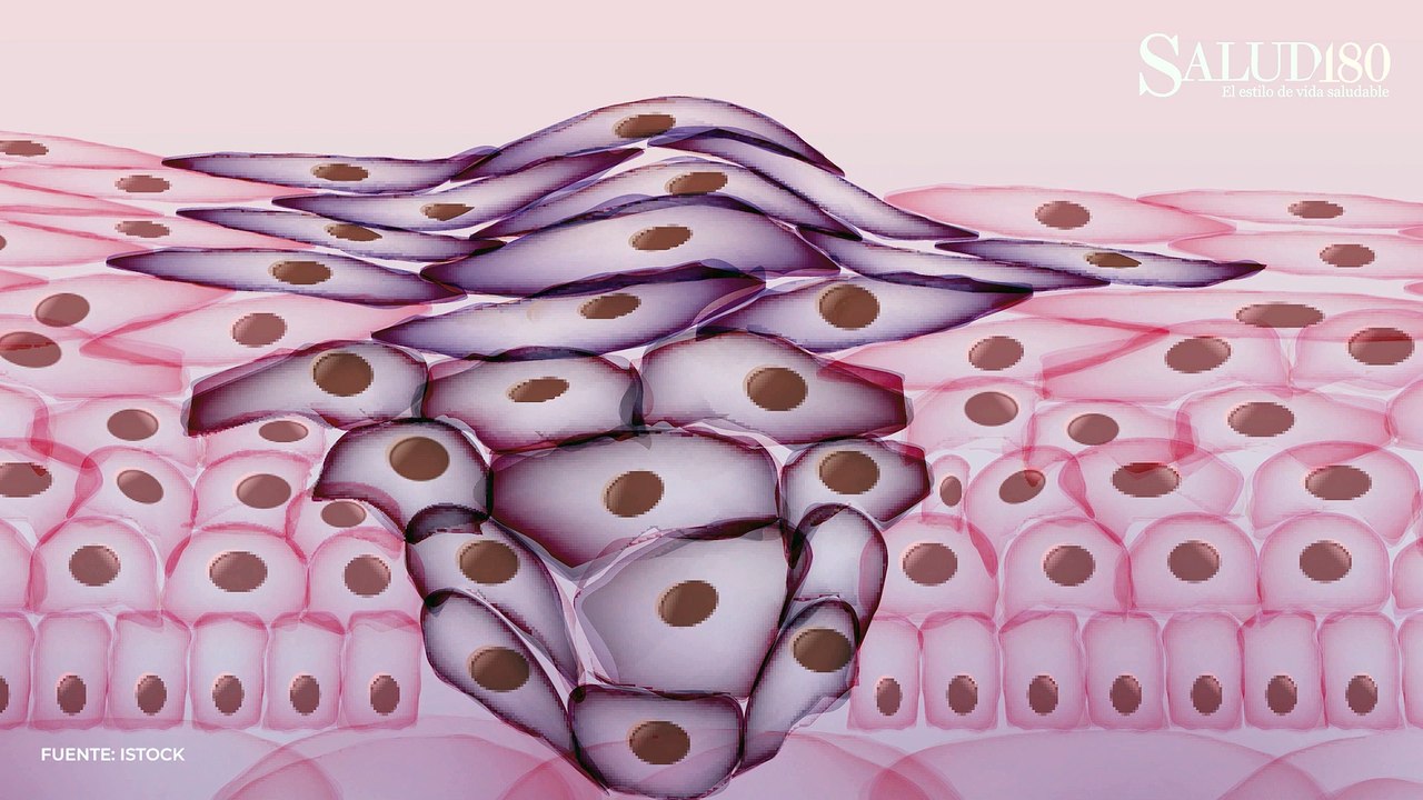 Bultos en las articulaciones ¿Son peligrosos? | Salud180