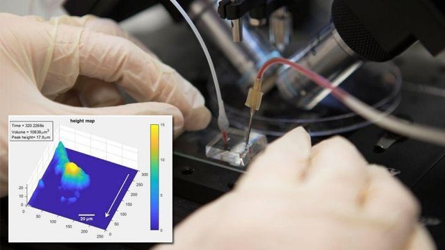 Invention a 'game changer' in preventing strokes and heart attacks