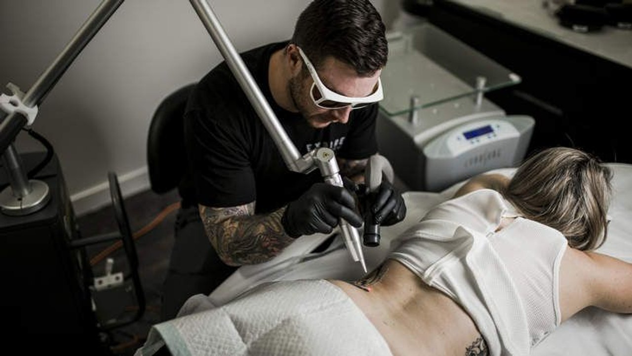 Tattoo removal session