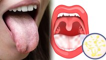 जीभ पर सफेद परत का कारण, Oral Thrush क्या होता है | Jeebh Me Safed Parat Ka Karan | Boldsky