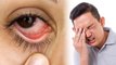 आंखों में आंसू न आना Dry Eye Syndrome के लक्षण,क्या है कारण और बचाव | Boldsky
