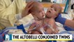 Formerly Conjoined Twins Enjoying 'Normal' Life at Home After Separation Surgery: 'We're So Happy'