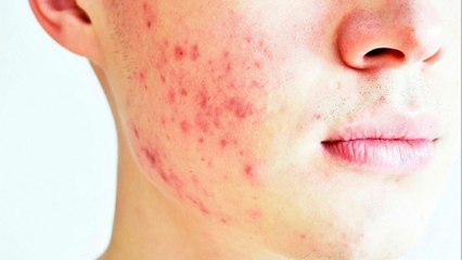 bd-como-tratar-la-piel-despues-del-acne-160222