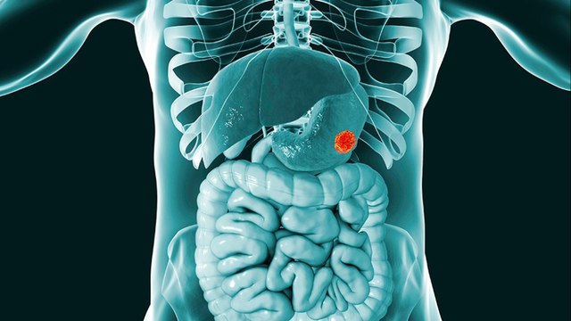 bd-el-cancer-de-estomago-sus-señales-tempranas-y-opciones-de-tratamientos-170222