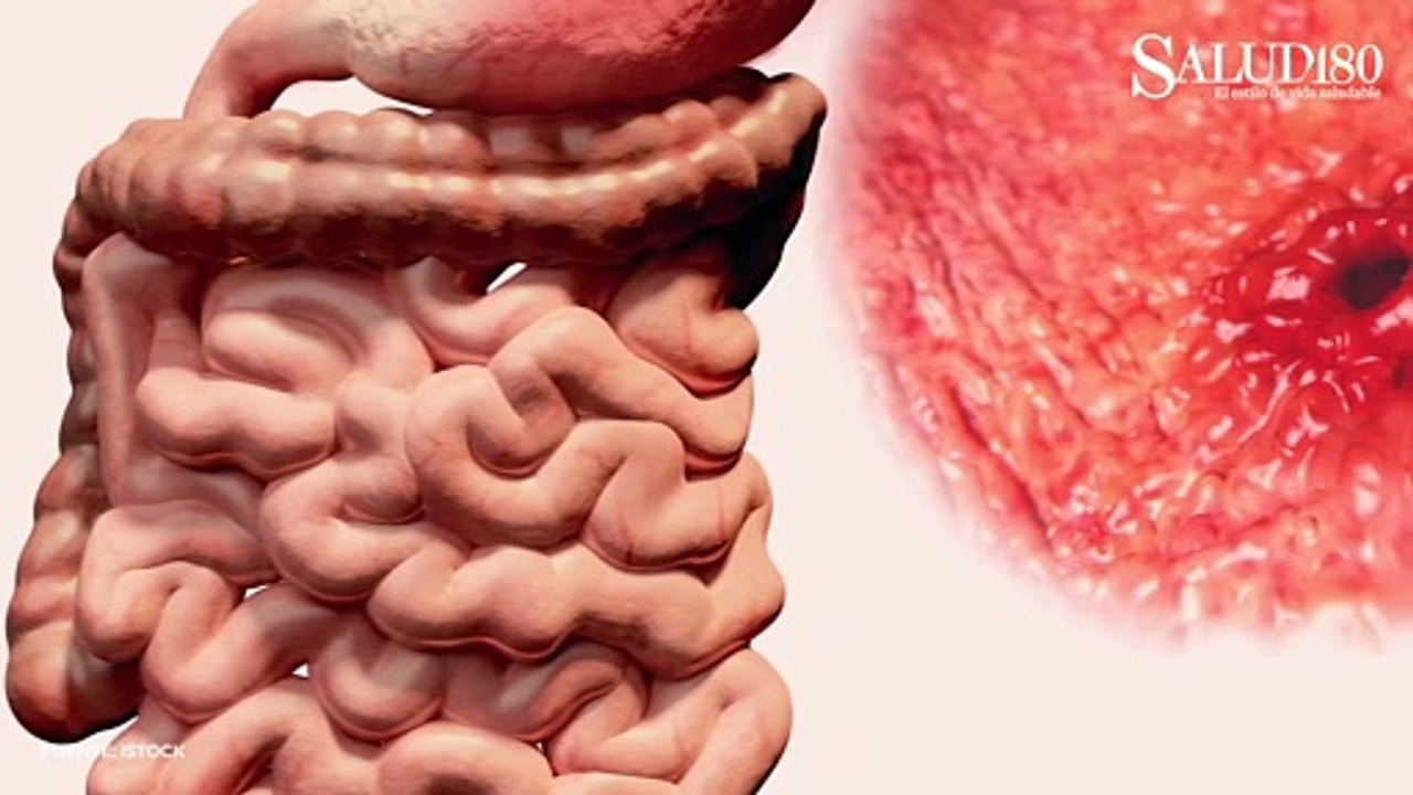 Perforación Gastrointestinal; 4 padecimientos "...