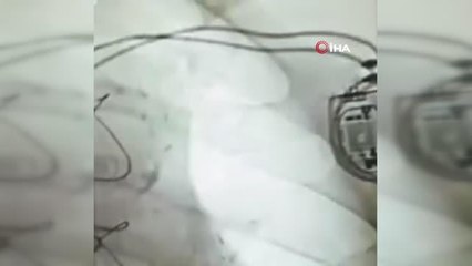 Covid-19 pozitif hastasına kalıcı kalp pilli takıldı
