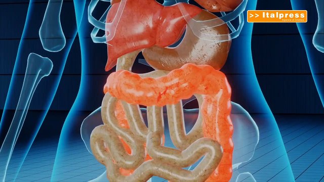 Malattie croniche intestinali, chirurgia sempre meno invasiva