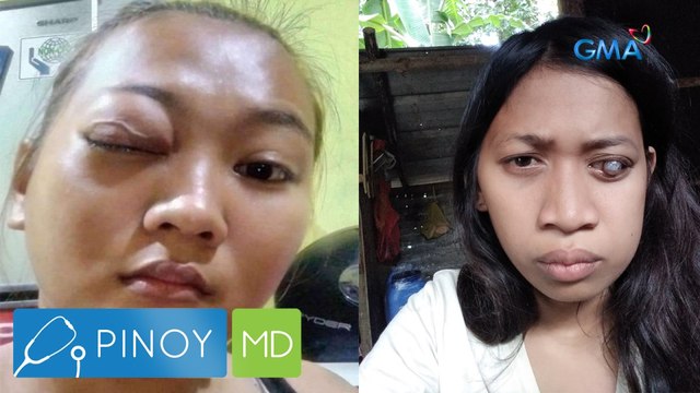 Pinoy MD: Pagkapuwing ng mata, posible bang maging sanhi ng komplikasyon?