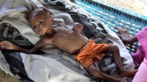 بالفيديو: الموت جوعا يهدد الطفلة رندا وملايين اليمنيين بسبب نقص المساعدات