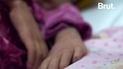 Inside the malnutrition ward of Kabul’s children’s hospital