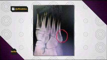 Zarul Umbrella alami kecederaan semasa berlakon