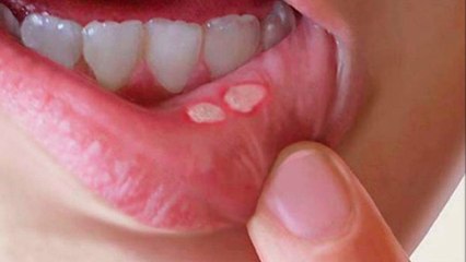 bd-vejigas-en-la-boca-como-tratarlas-240222