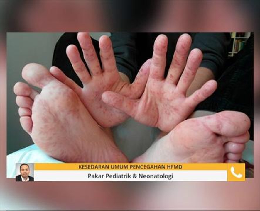 Kesedaran umum pencegahan HFMD
