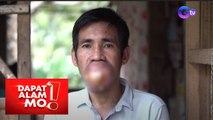 Dapat Alam Mo!: 43-anyos na tatay, hirap nang magsalita dahil sa malaking bukol sa bibig!