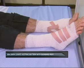 Sea swim leaves Australian teen with bloodied feet