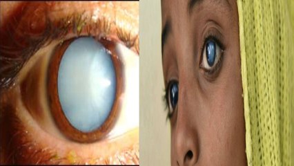 आंखो में धुंधलापन White Cataract के Symptoms, क्या है कारण और बचाव |Doctors Alert |  Boldsky