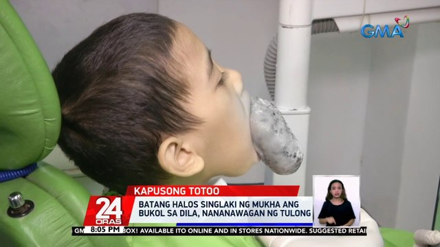 Batang halos singlaki ng mukha ang bukol sa dila, nananawagan ng tulong | 24 Oras