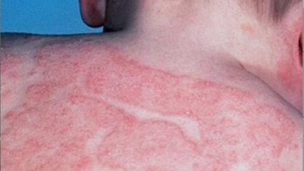 Ekzema & Impaknya dan #TipsPemakanan ketika Beraya