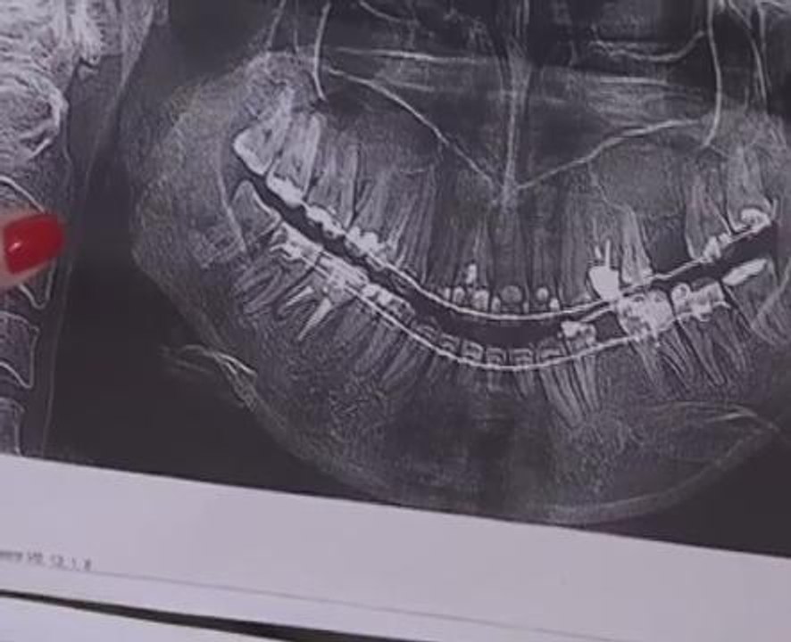 Russian dentist removes 22 healthy teeth Video Dailymotion