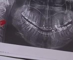 Russian dentist removes 22 healthy teeth