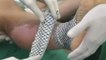Brazilian doctors use fish skin to treat burn victims