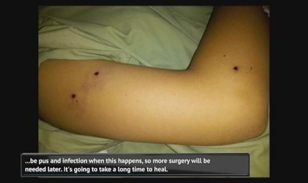 Girl hit by stray bullets: Possible year-long wait for next surgery