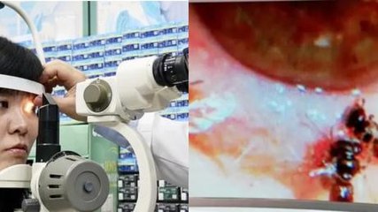 She went to the doctors for eye pain and they found something moving inside