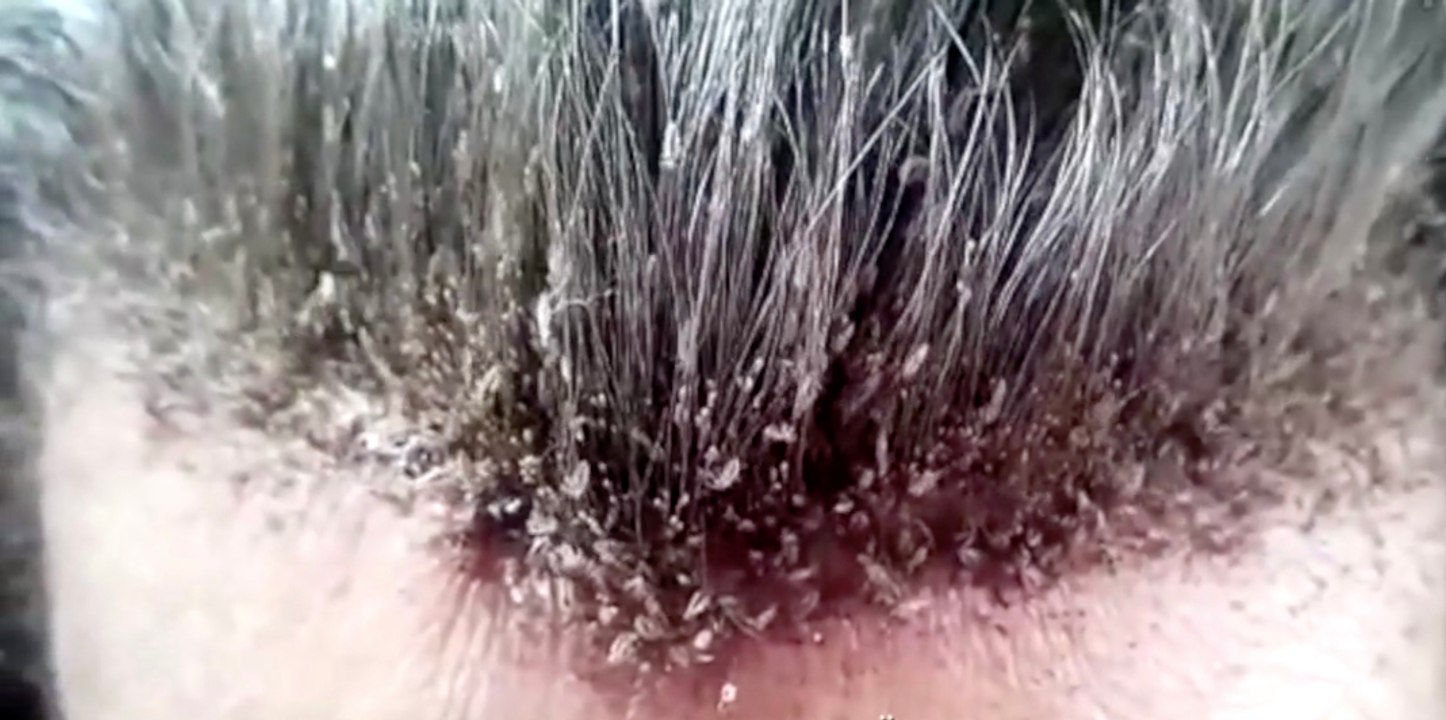 Es wimmelt nur so: Sie hat hunderte Tiere auf dem Kopf