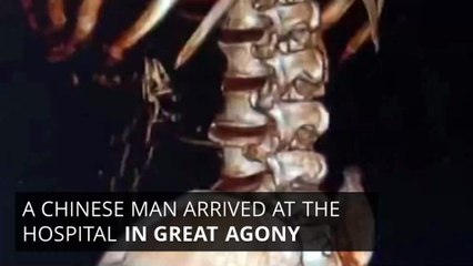 Man Swallows Live Eels to Treat His Constipation and Immediately Regrets It!