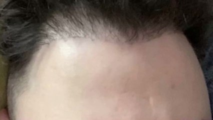 UK man warns others after £1,200 hair transplant left him badly scarred