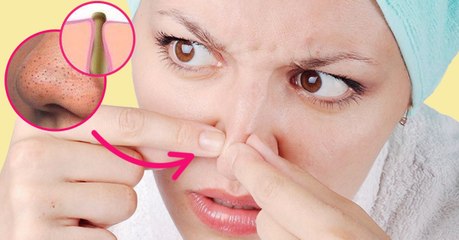 This is the kind of blackhead that you should never ever pop