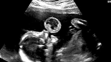 They Thought She Was 'Blowing A Bubble’ On The Scan - But The Truth Was Frightening